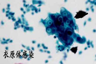 衣原体感染