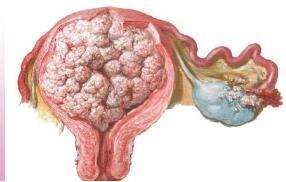 子宫内膜增生复发怎么治疗？