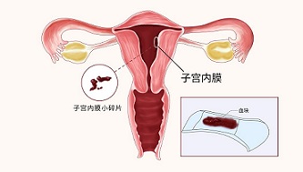 子宫内膜炎例假特点