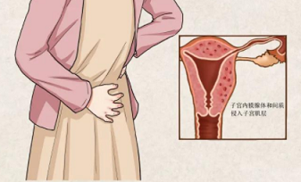子宫腺肌症肚子痛经量多可以吃妇炎丸吗?