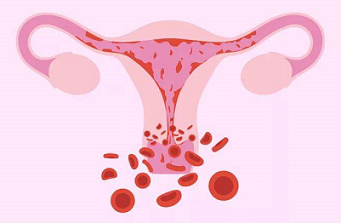 子宫内膜增生的10个征兆