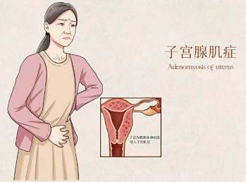 子宫腺肌症会引起什么并发症?