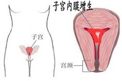 子宫内膜增生的预防措施