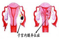 子宫内膜异位症食疗