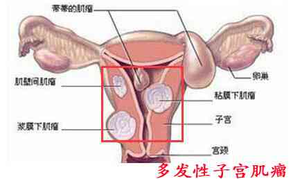 多发性子宫肌瘤