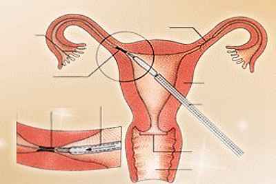 治疗输卵管阻塞