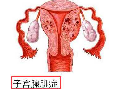 子宫肌腺症