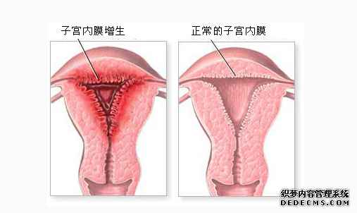 子宫内膜增生吃什么药