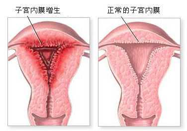 妇炎丸治疗子宫内膜增厚有用
