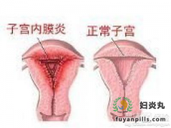 子宫内膜炎是什么原因造成的?