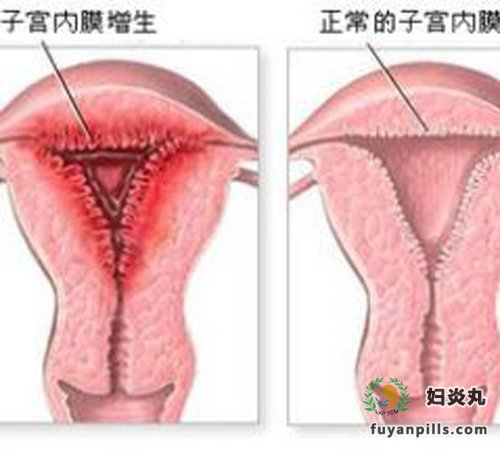 子宫内膜增生是什么病?有哪些症状呢?