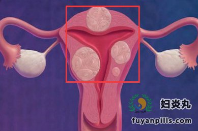 子宫腺肌症的诊断依据有哪些?