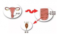 中医治疗滴虫性阴道炎的方法有哪些？