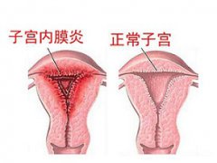 子宫内膜炎会导致子宫内膜增厚吗