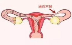 为什么女性会出现输卵管通而不畅的现象?