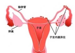 中医治疗子宫内膜异位症的方法