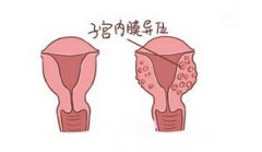 运动导致子宫内膜异位症该怎么办