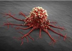 高效卵巢癌疗法缩小近半患者肿瘤