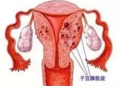 子宫腺肌症会表现出哪些症状体征