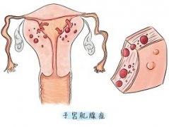 子宫腺肌症会导致子宫内膜变厚吗?