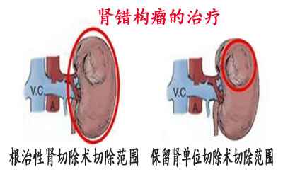 肾错构瘤