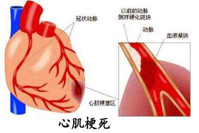 心肌梗死