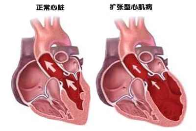 扩张性心肌病