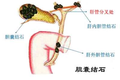 胆囊结石