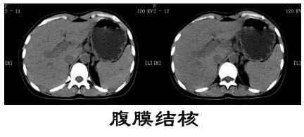 腹膜结核