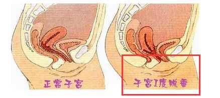 子宫脱垂