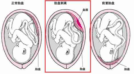 胎盘早剥