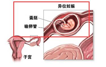 输卵管妊娠