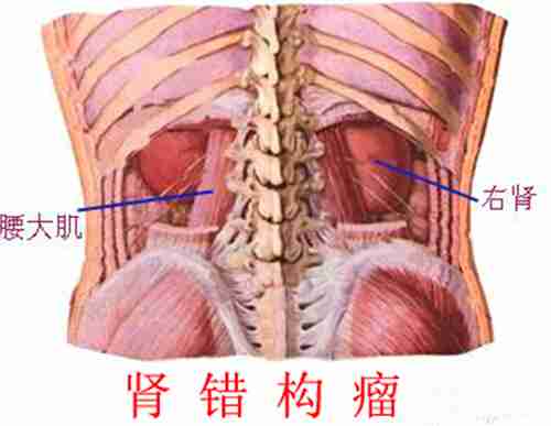 肾错构瘤