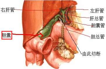 胆囊多发结石