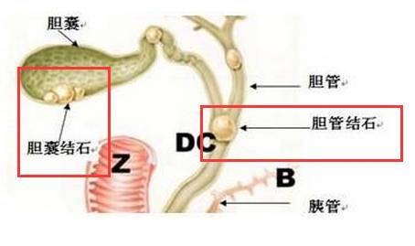 胆结石