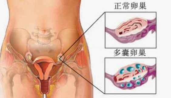 多囊卵巢综合征