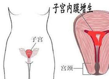 妇炎丸治疗子宫内膜增生