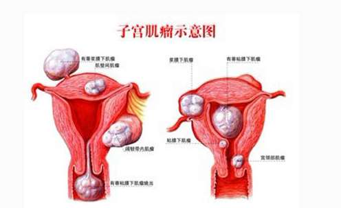 妇炎丸能治疗子宫肌瘤吗