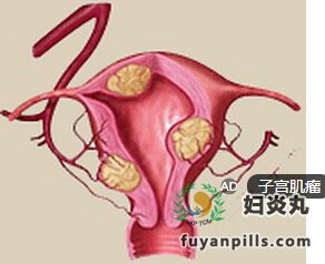 腹部肿大无妊娠反应要警惕子宫肌瘤