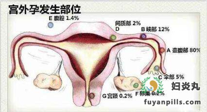 哪类女性更易患宫外孕