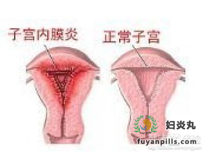 子宫内膜炎是什么原因造成的