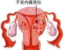 子宫内膜异位症怎么预防？