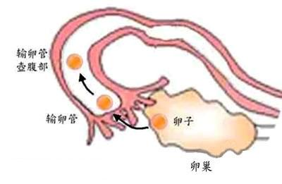 输卵管堵塞