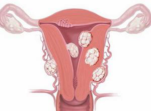 子宫内膜不典型增生