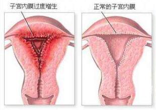 子宫内膜增生