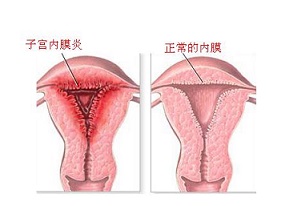 子宫内膜增生有哪些类型?