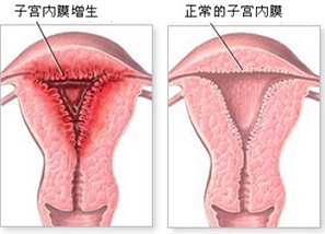 女性子宫内膜增厚怎么办