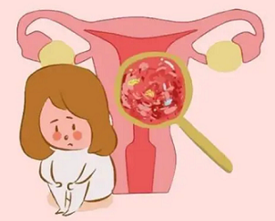 子宫内膜增生有何特点?