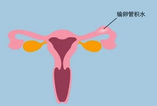 输卵管积水消除后能正常怀孕吗?