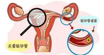 输卵管积水和堵塞有什么区别